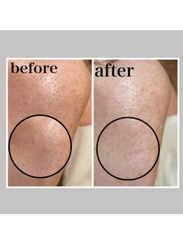 毛穴専科/ワックス脱毛メンズok/沖縄/那覇