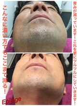 美容脱毛専門サロン エピラージュ 新宿店(Epilage)/青髭もお任せ！