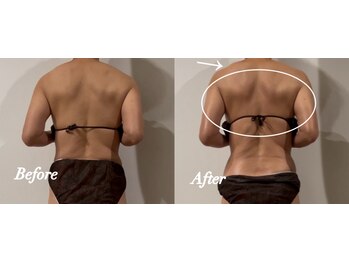 ステラ(Stella)/痩身(背中)