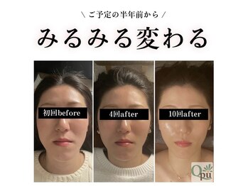 キュープ 鹿児島伊集院店(Qpu)/イベント前は小顔矯正がおすすめ