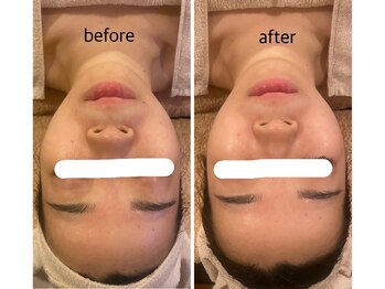 うつくし痩身 美サロン ゼットワン(Z-ONE)/フェイシャル　カーボキシーケア