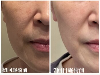 フルオール(FRUOR)/プラズマシャワー