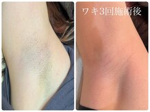 シフォン(Chiffon)/ワキ脱毛３回施術後