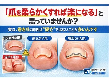 巻き爪じゅん 千葉駅前店/爪を柔らかくするケアは必要？
