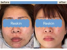 リスキン(Reskin)の雰囲気（【LDM+他施術の組み合わせ】月に1度の施術で肌は変わります!!）