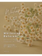 スリール(sourire)/ホワイトニングBefore After