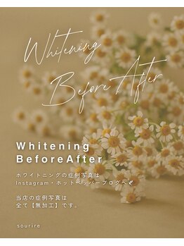 スリール(sourire)/ホワイトニングBefore After