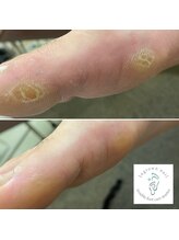 トルフル(TORUFUL)/スポーツでのたこケアも可能☆