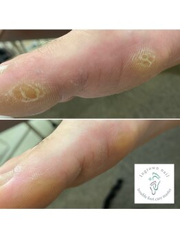 スポーツでのたこケアも可能☆