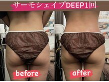 リラクゼーションサロン ラキ(laki)/サーモシェイプDEEP1回30代/痩身