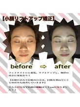 ラクラク(rakuraku)/【小顔リフトアップ矯正】