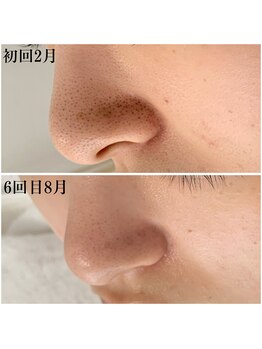 プラセル(Placer)/少しずつですが着実に☆