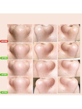 サロン ド マハロ(Salon de MAHALO)/毛穴エクストラクション