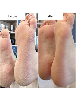 ケアプラス(care plus)/足裏角質ケア