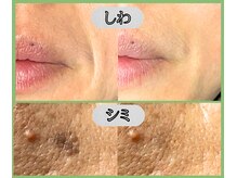 スリー ときわ台(Three)の雰囲気（エイジングケアに◎【ニードルピーリング施術前→施術後】）