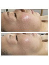 ヒラキヒミ。/毛穴洗浄エステ