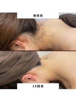 ミース 北九州店/うなじ★ビフォーアフター