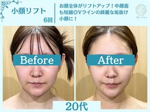 フローフシ∞/【小顔】切らない小顔リフト