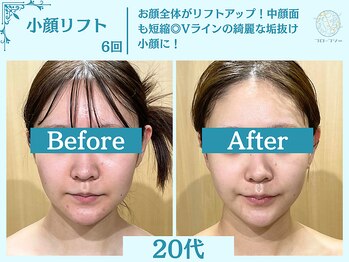 フローフシ∞/【小顔】切らない小顔リフト