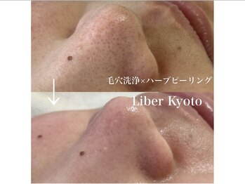 エステティック リベル キョウト 京都駅前店(Esthetic Liber Kyoto)/毛穴洗浄×ハーブピーリング
