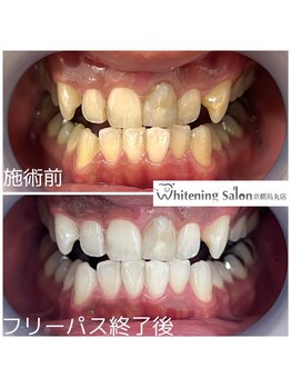 ホワイトニングサロン 京都烏丸店/ホワイトニング施術例