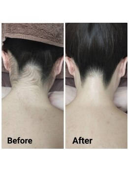 サロン ピューパ(Salon pupa)/花嫁様うなじ　before→after