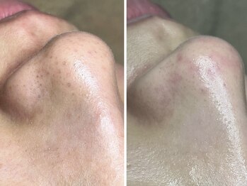 エヌエクラ(N.eclat.)/鼻