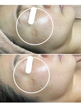 ルーチェエムベルシック(Luce.MBelChic)/40代女性シミケア歴6カ月