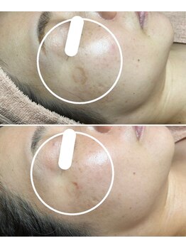 ルーチェエムベルシック(Luce.MBelChic)/40代女性シミケア歴6カ月