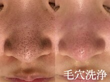 サロン ラズリ 久留米店(SALON Lazuli)/【毛穴洗浄】角質・角栓を改善