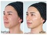 【黒ずみ鼻・毛穴締め・ハリ艶】韓国式３D毛穴洗浄＋３D水光ピーリング