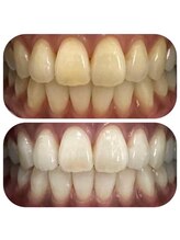 ボッカ(bocca)/ホワイトニングBefore After