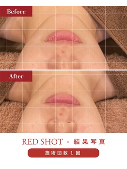 ハレア(HALEA)/レッドショット下顔面 2cc B/A