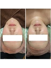 カヌヌ(Kanunu)/小顔リフト