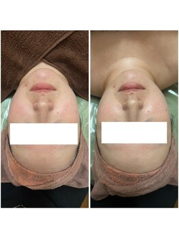 カヌヌ(Kanunu)/小顔リフト