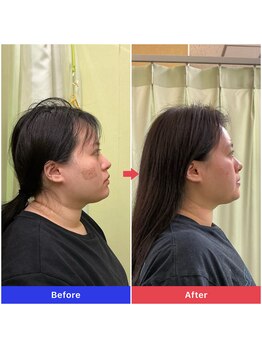 整音(totonone)/フェイスライン・首の細さ