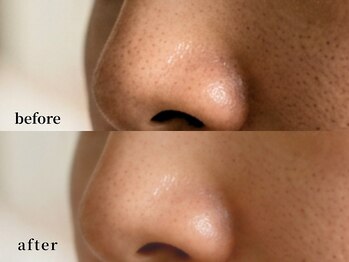 ソレイユ(Soleil)/毛穴の開き・黒ずみ