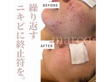マルコ(marco)の雰囲気（marcoニキビケアシステム/繰り返すニキビ、毛穴）