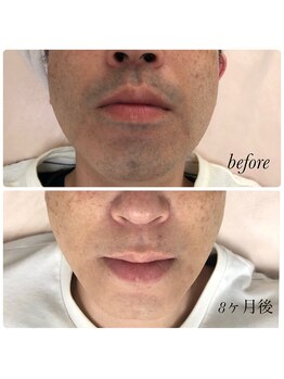 ベルフィーヌボーテ(BELFINE beaute)の写真/【青ヒゲ改善実績あり】毎朝のヒゲ剃りがラクになるメンズ脱毛◎