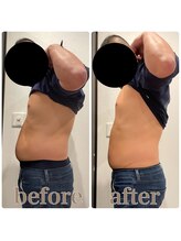 ファビー(Fabby)/マグフォース1回のビフォアフ