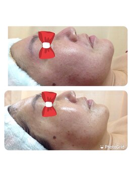 健康センター トロイカ/ラジオフェイシャル+炭酸パック