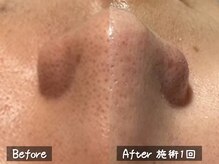 ココモンド(COCOMONDO)/ハイドロ毛穴洗浄/毛穴/毛穴洗浄