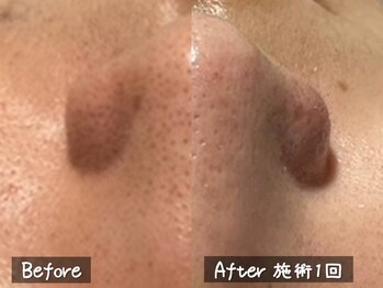 ココモンド(COCOMONDO)/ハイドロ毛穴洗浄/毛穴/毛穴洗浄