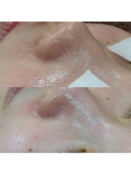 ボーソリューション(Beau-Solution)/【20代　開き毛穴・黒ずみ毛穴】