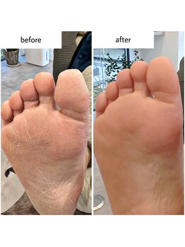 ケアプラス(care plus)/足裏角質ケア