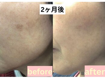 アドミーロ/セラム&サロン2ヶ月☆計4回