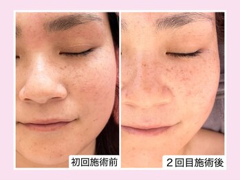 カレン アイビューティー(Karen Eyebeauty)/ララピール初回施術前と２回目☆