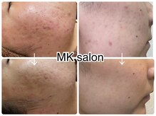 エムケーサロン(MK salon)の雰囲気（10日に1回ハーブピーリング。ニキビ、赤み）