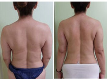 ソフィーム/痩身　初回施術後