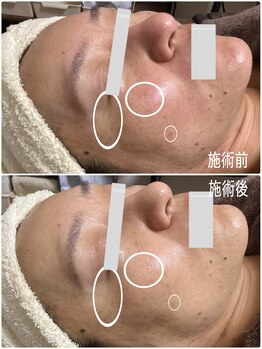 ブライトリー(Brightly)/月1サロンケア+自宅で肌質改善